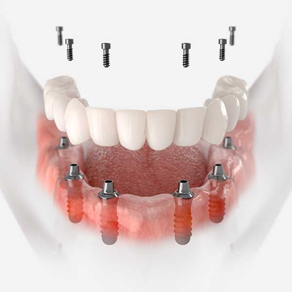 all on 6 dental implant
