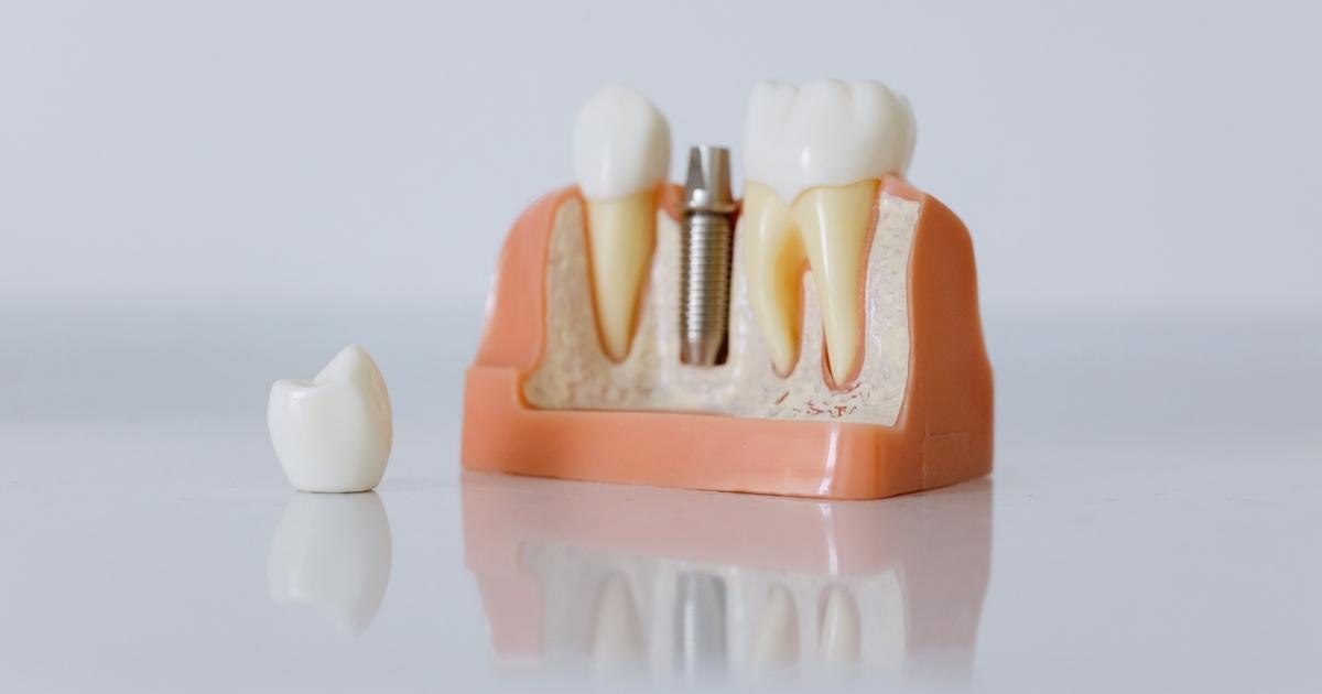 Aesthetics Comparison_ Dental Implants or Bridges