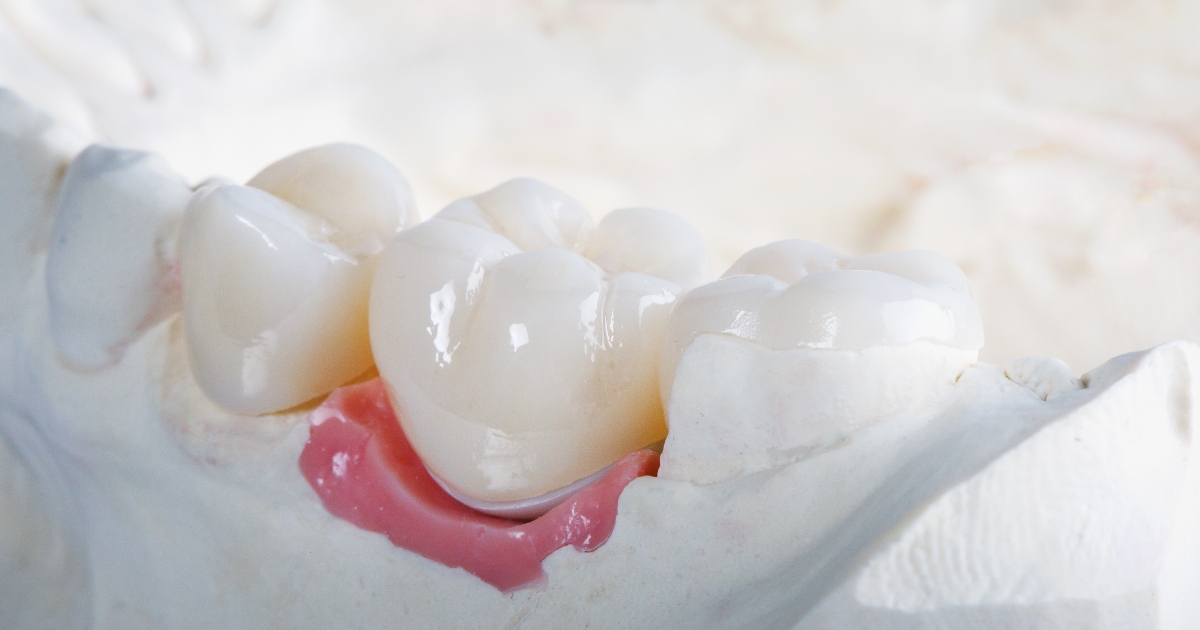 Ceramic Fillings_ A Cosmetic Alternative Available at the Best Dental Clinics in Dubai