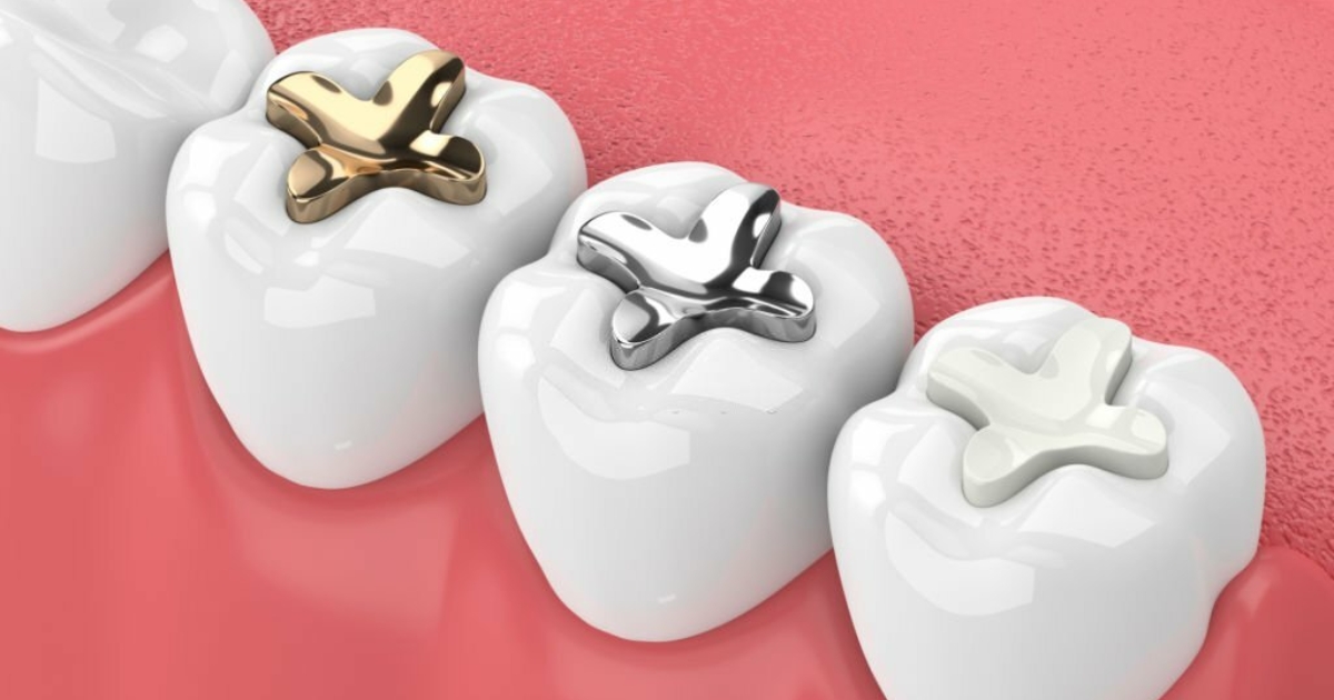 Gold Dental Fillings_ The Luxurious and Long-Lasting Option in Dubai