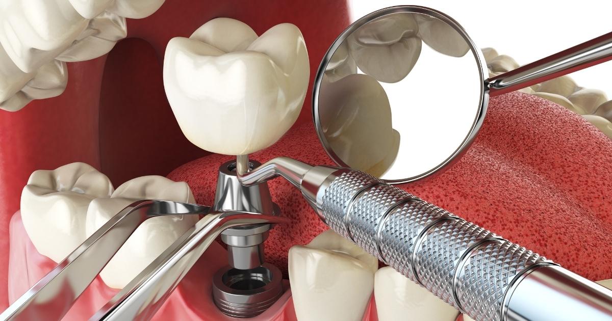Pros and Cons_ Dental Implants vs. Bridges