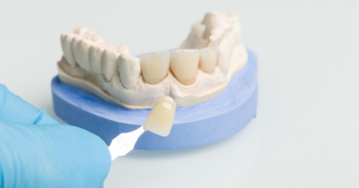 The Lifespan of Veneers and Their Resistance to Staining