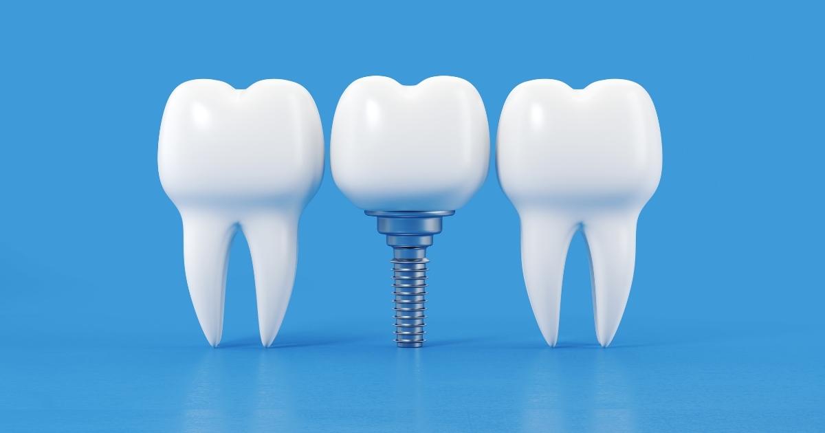 The Material and Design of Dental Implants_ Factors that Affect Longevity