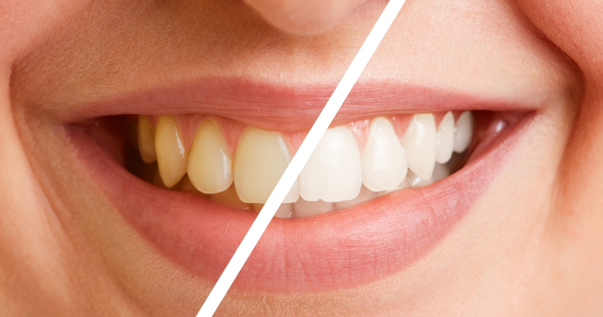 Transform Your Smile_ The Power of Before-and-After Veneers