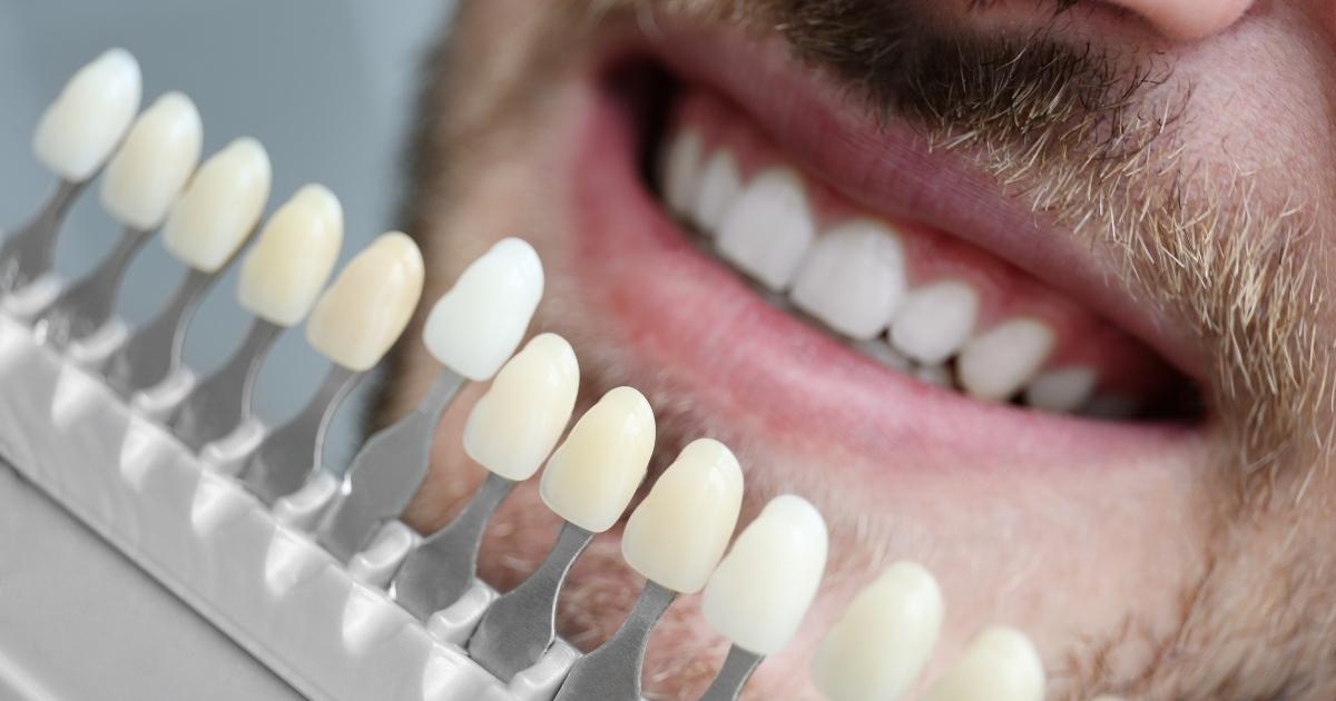Understanding Dental Veneers_ A Brief Overview