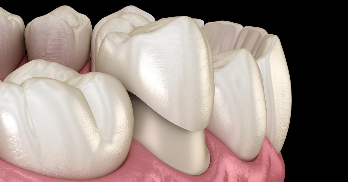 What Are Dental Crowns and How Do They Work